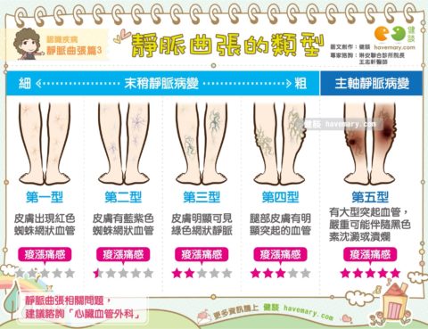 靜脈曲張症狀、併發症與急症