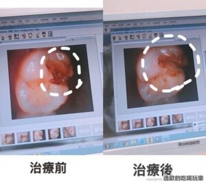 蛀牙不必做牙套-3D齒雕還你健康牙齒