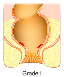痔瘡分級-第一度