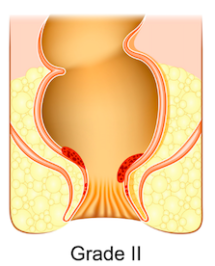 痔瘡分級-第二度