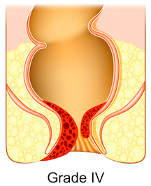 痔瘡分級-第四度